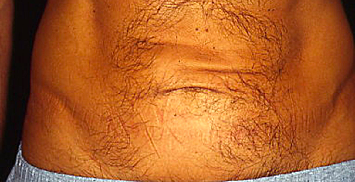 Male mini tummy tuck