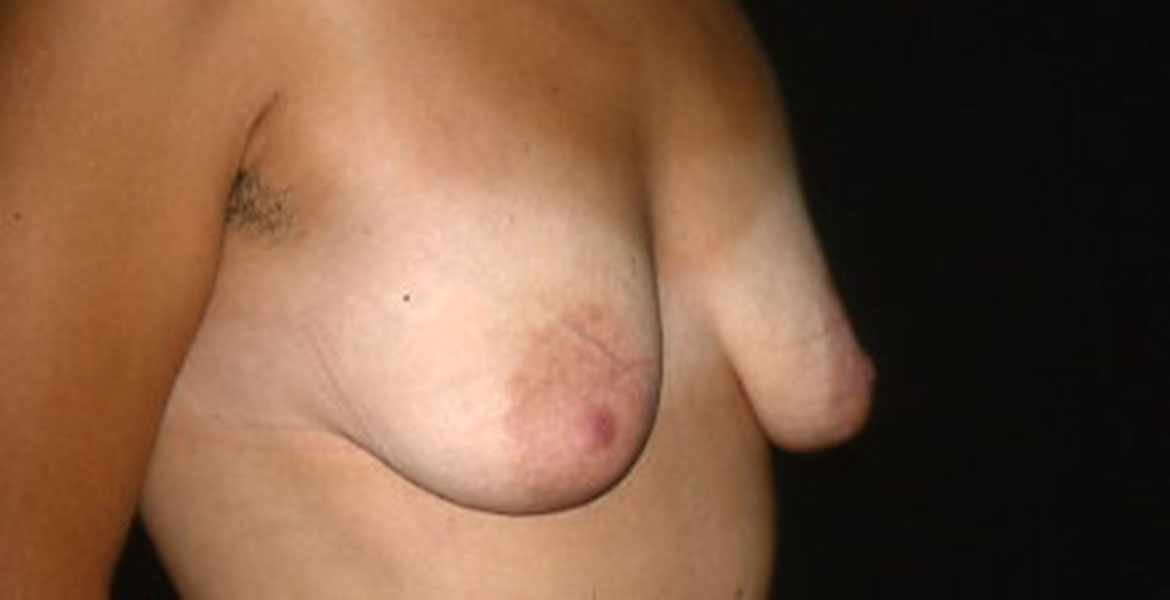 Mastopexy with no implant