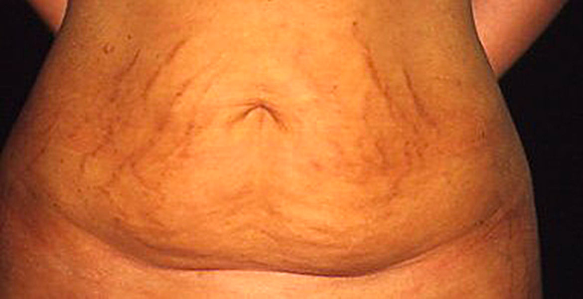 Lipoabdominoplasty