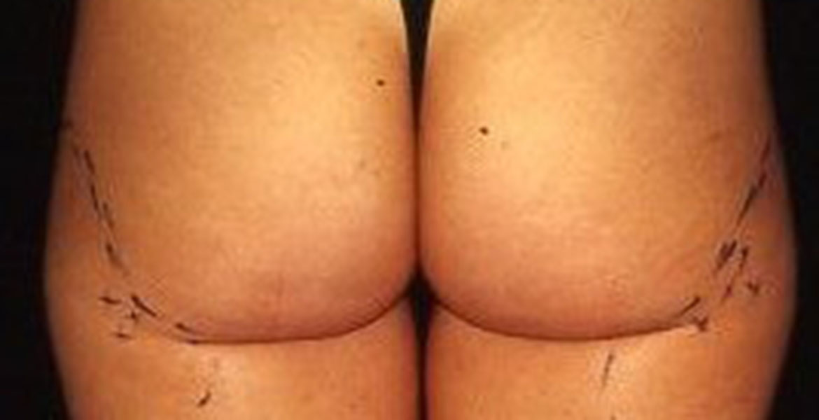 Buttock contouring liposculpture