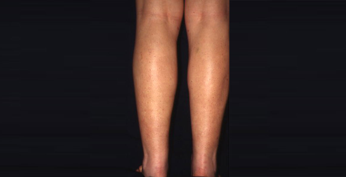 Calf liposculpture