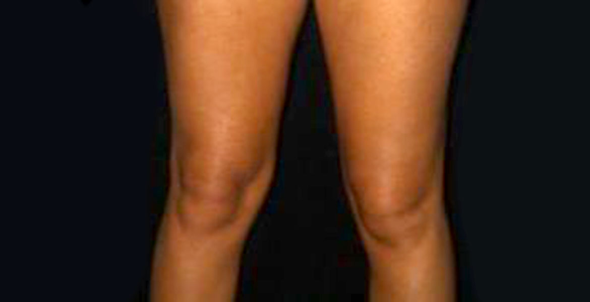 Knees liposculpture