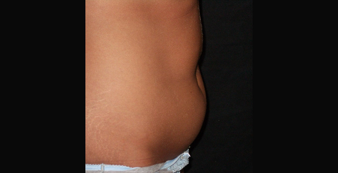 Complete abdomen liposculpture