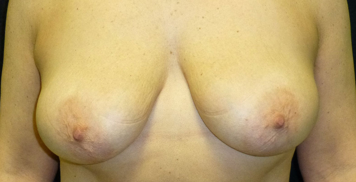 Vertical mastopexy