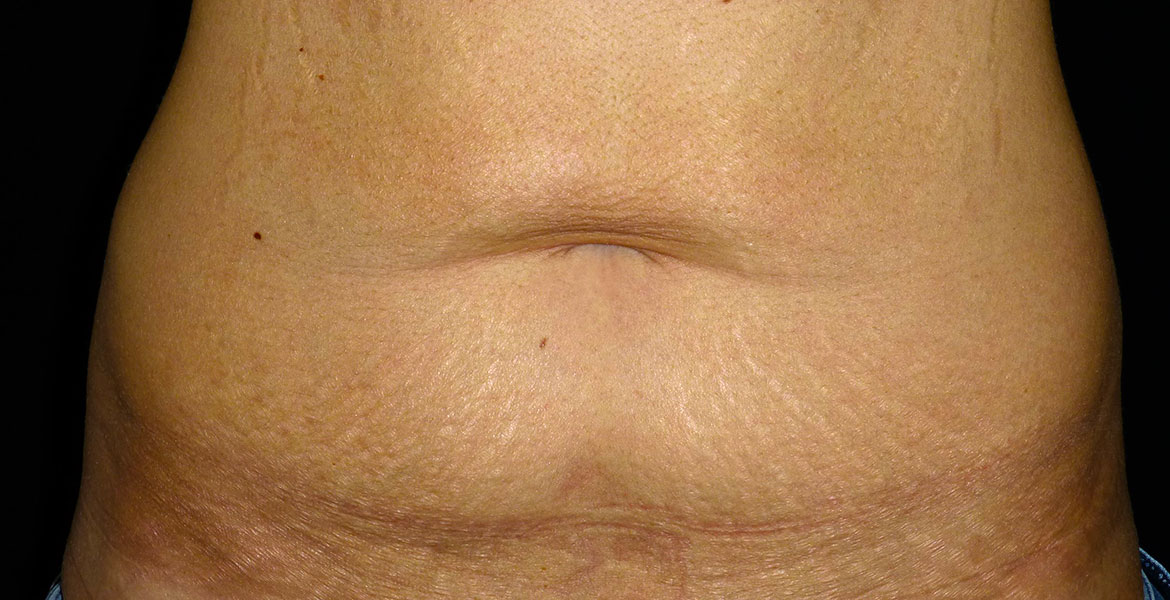 Tummy tuck