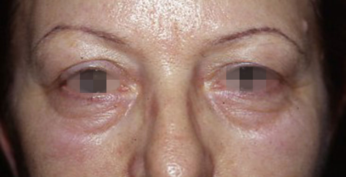 Total blepharoplasty