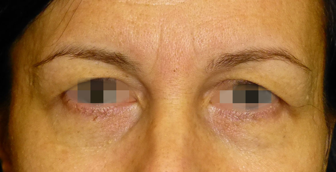 Upper blepharoplasty