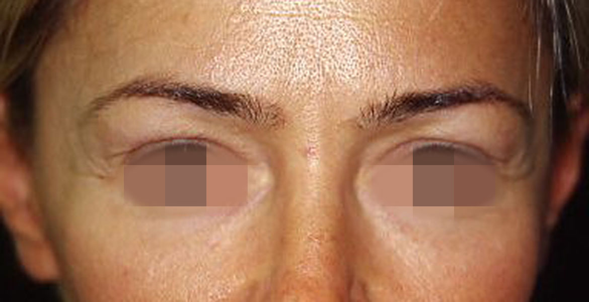 Blepharoplasty and botulinum