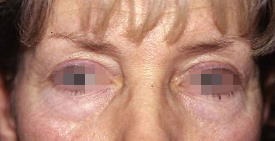 Lower blepharoplasty