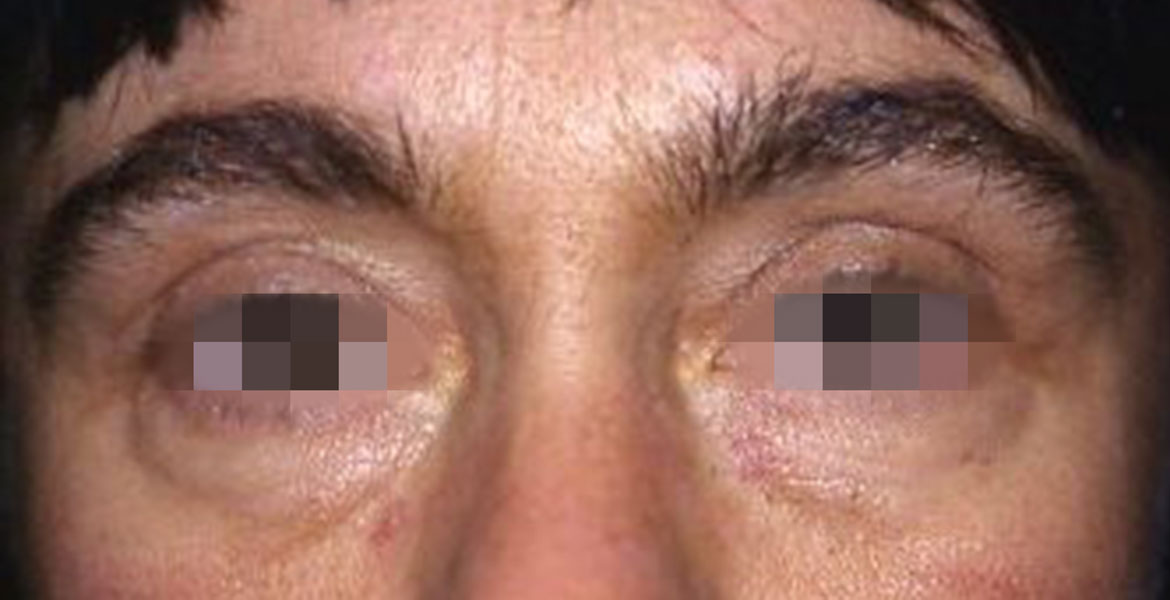 Lower blepharoplasty 2