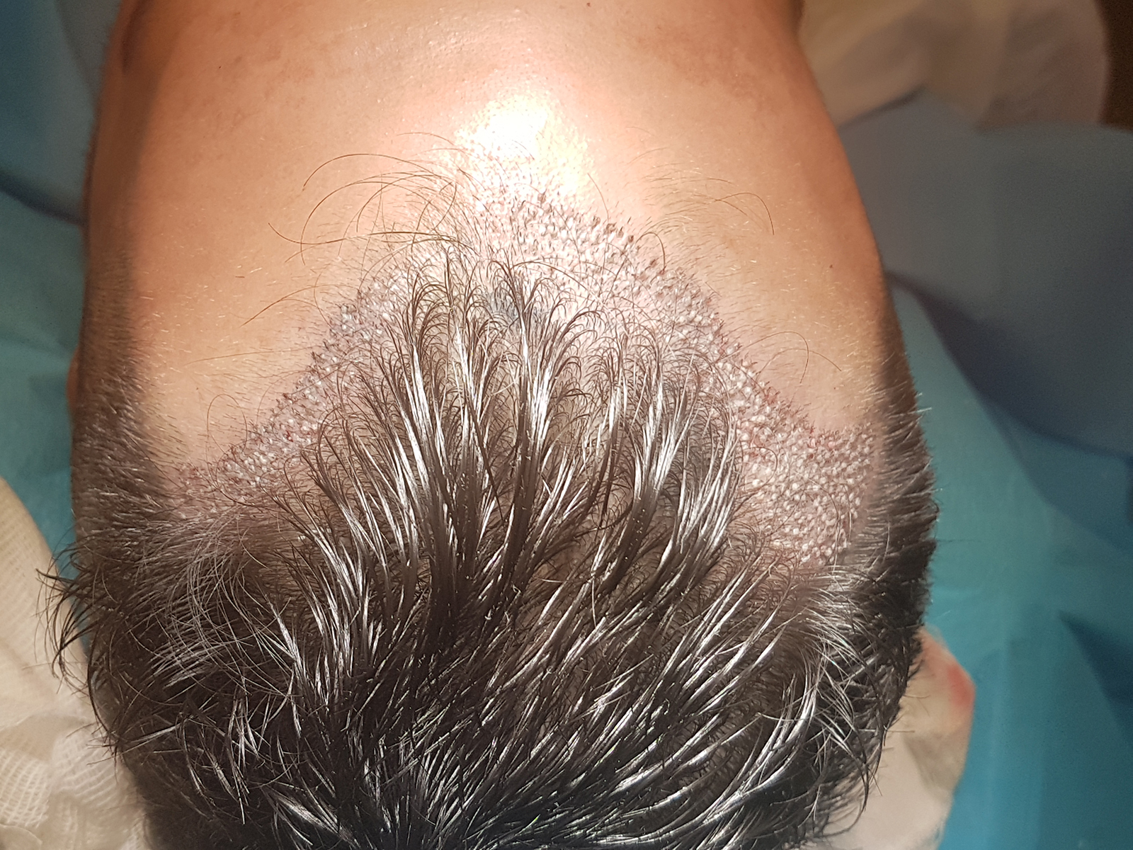FUE Intraop