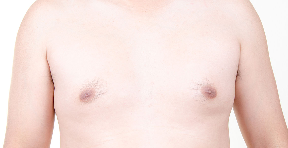 Gynecomastia