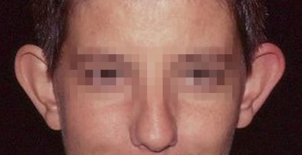 Mustardè otoplasty