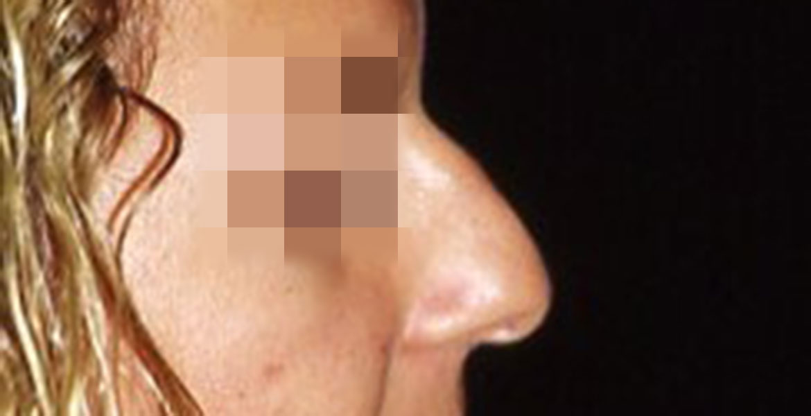 Aesthetic rhinoplasty