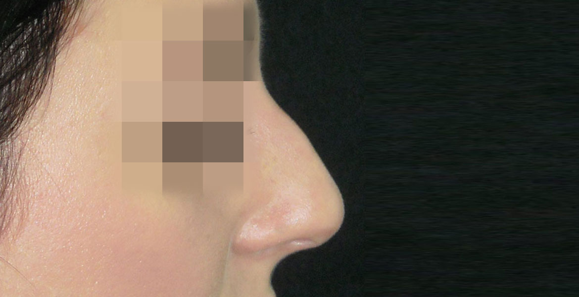 Open rhinoseptoplasty