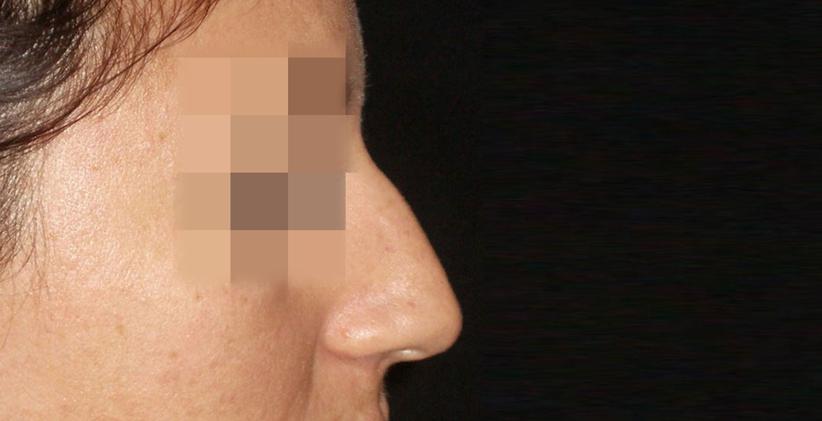 Closed rhinoplasty