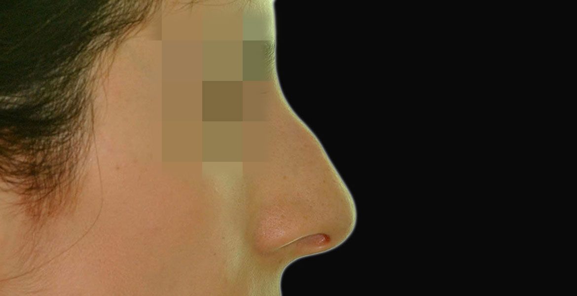 Closed rhinoseptoplasty