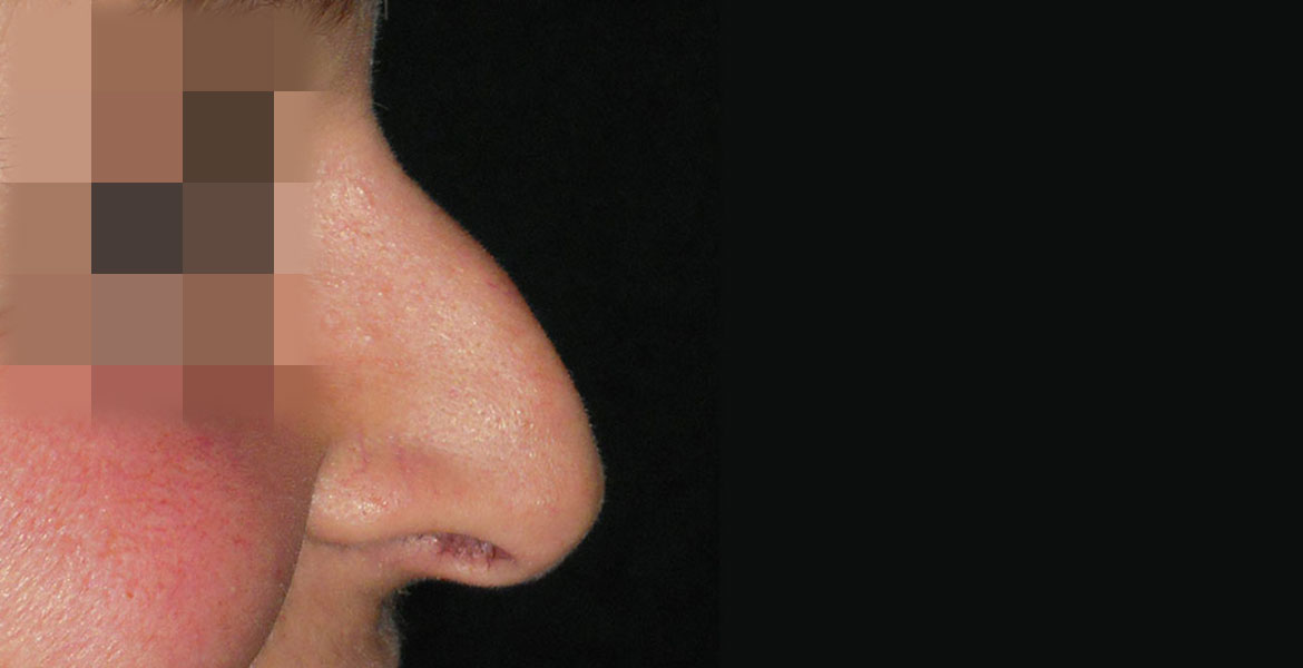 Rhinoseptoplasty and botulinum